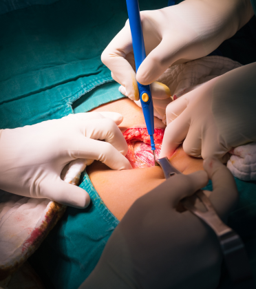 Best Appendix Surgeon in Delhi