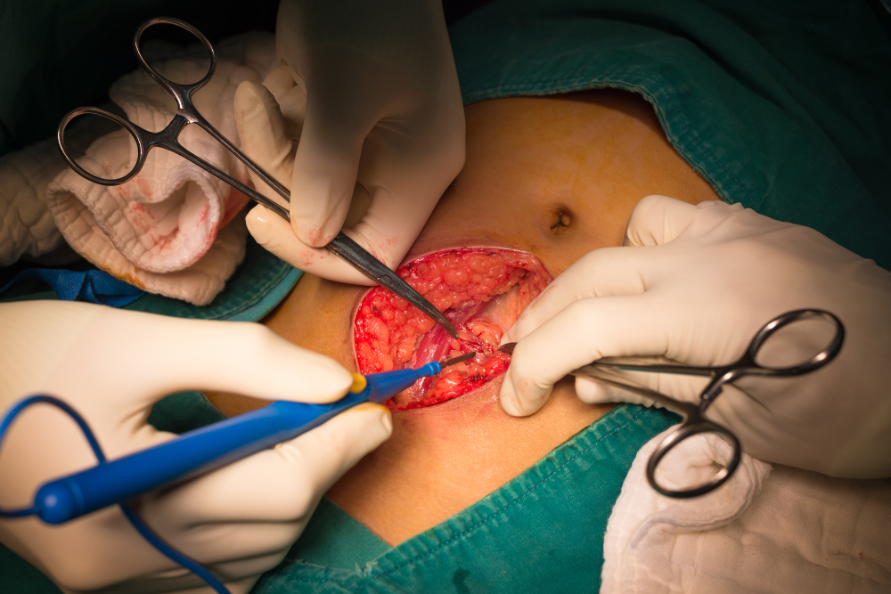 Advanced Appendix Surgery in Delhi