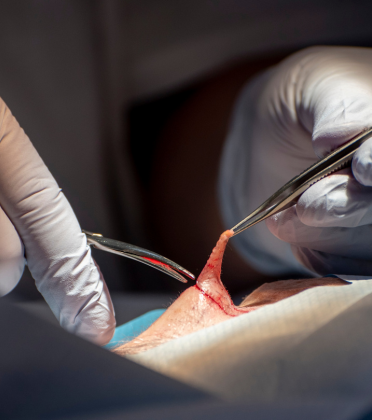 Best Esophageal Cancer Surgeon in Delhi