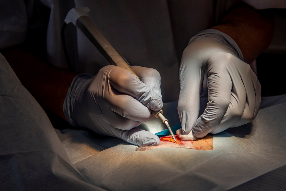 Advanced Esophageal Cancer Surgery in Delhi