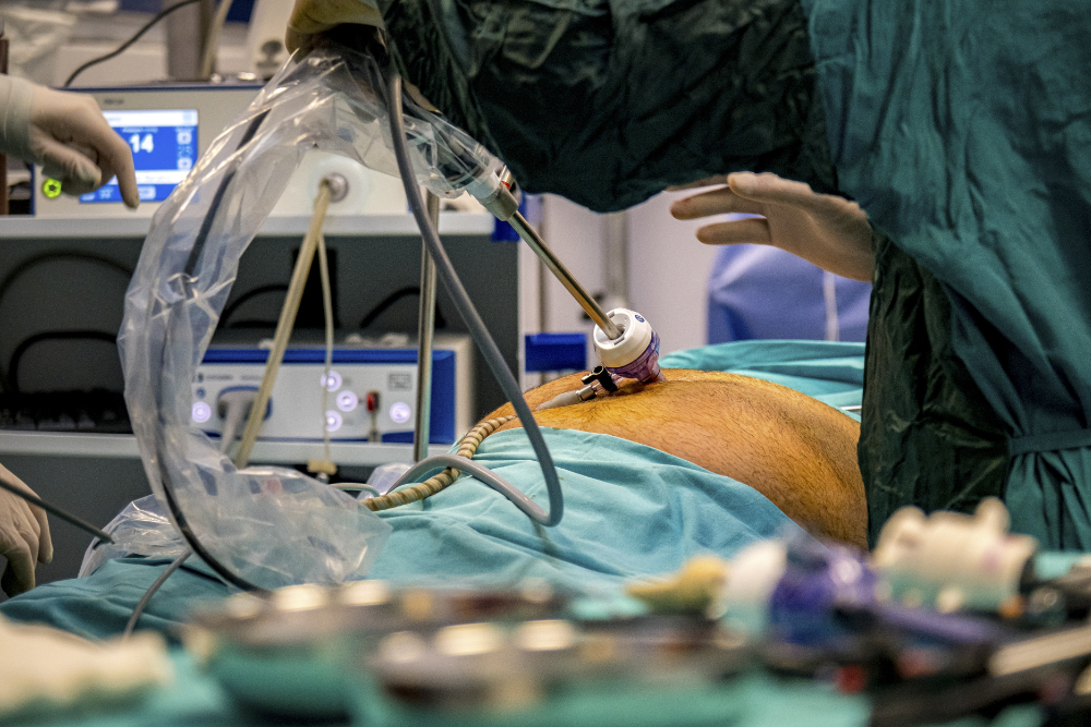 Advanced Gastric Bypass Surgery in Delhi