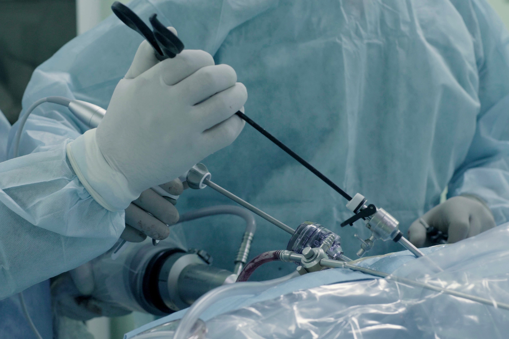 Advanced Laparoscopic Upper GI Surgery in Delhi