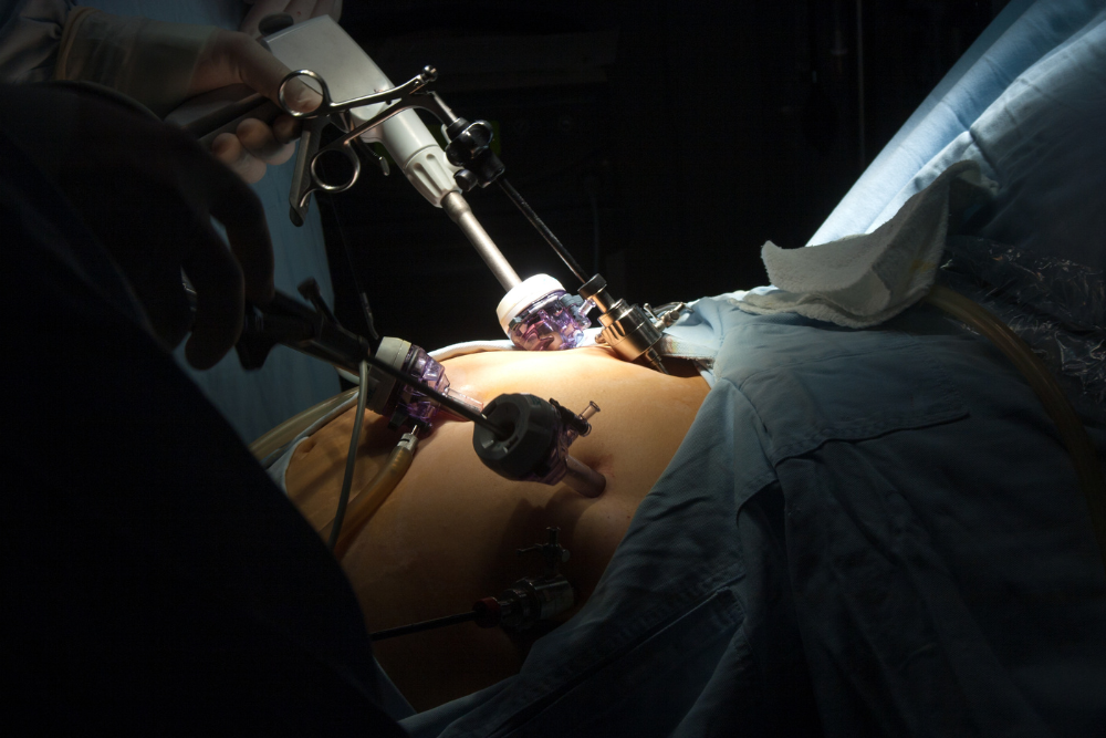 Advanced Mini Gastric Bypass Surgery in Delhi