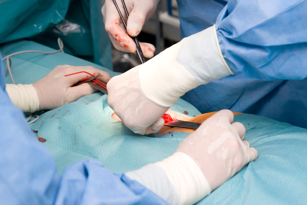 Advanced Recurrent Hernia Repair in Delhi
