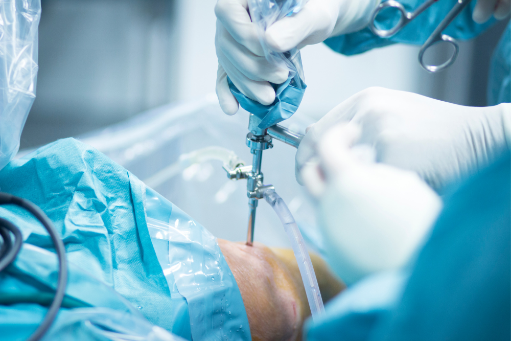 Advanced Sports Hernia Surgery in Delhi