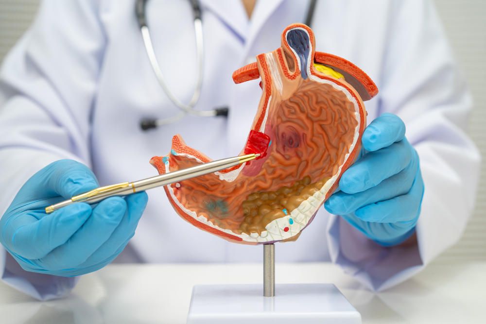 Advanced Stomach Cancer Surgery in Delhi