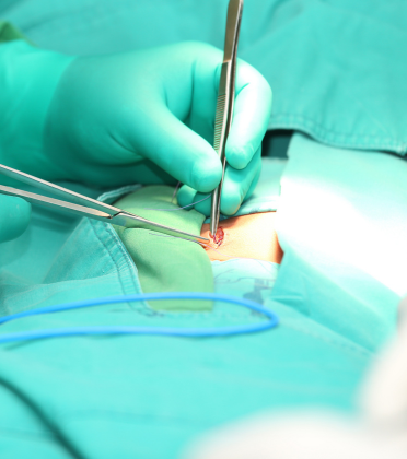 Best Umbilical Hernia Surgeon in Delhi