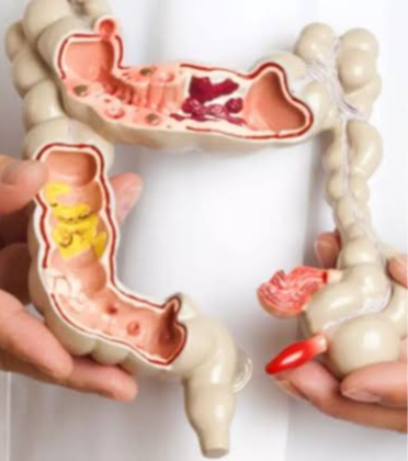 Colon Surgery by Dr. Arun Prasad