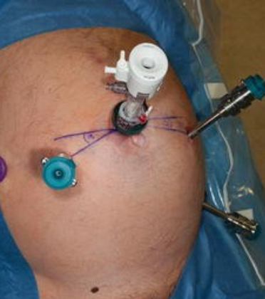 Rectal Prolapse Surgery by Dr. Arun Prasad