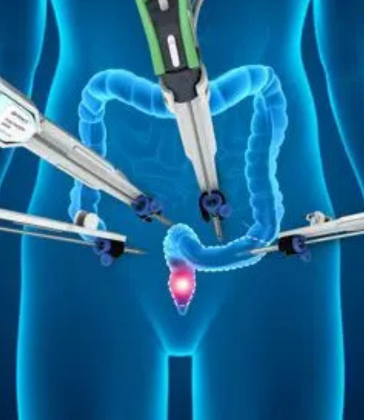 Robotic Colorectal Surgery by Dr. Arun Prasad