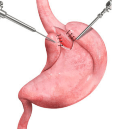GERD Surgery by Dr. Arun Prasad