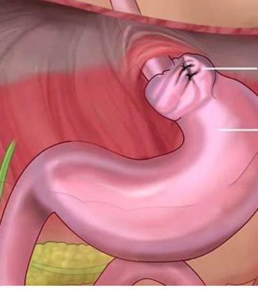 Fundoplication Surgery by Dr. Arun Prasad