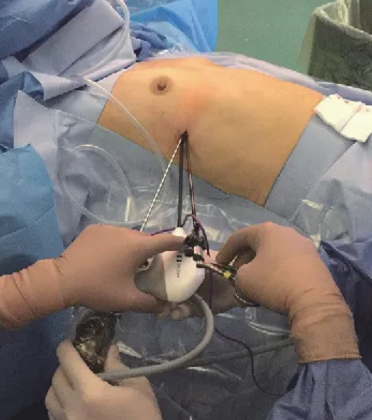 Myasthenia Gravis Surgery by Dr. Arun Prasad