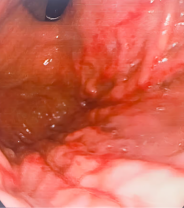 Hiatal Hernia Surgery by Dr. Arun Prasad
