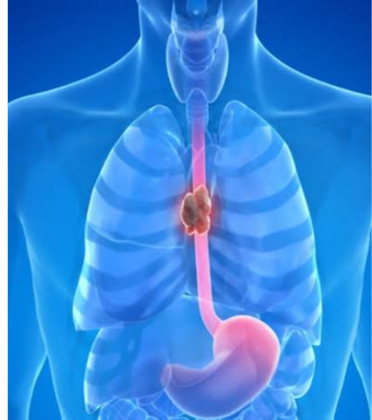 Esophageal Surgery by Dr. Arun Prasad