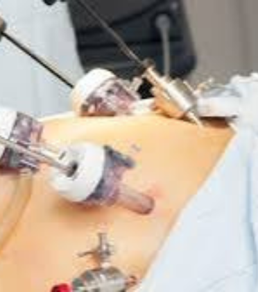 Paraesophageal Hernia Repair by Dr. Arun Prasad