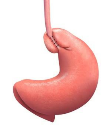 Anti Reflux Surgery by Dr. Arun Prasad
