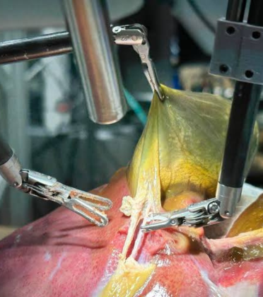 Advanced Robotic Abdominal Surgery by Dr. Arun Prasad