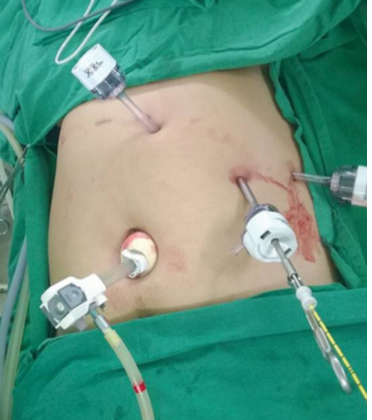 Best Laparoscopic Cholecystectomy Surgeon in Delhi
