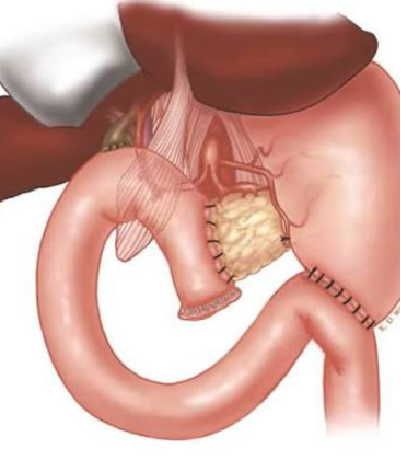 Best Whipple Procedure Surgeon in Delhi