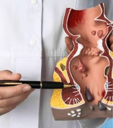 Piles Treatment by Dr. Arun Prasad