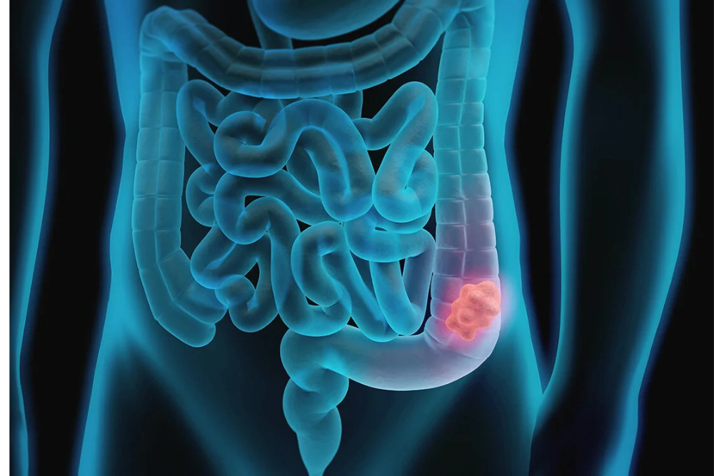 Advanced Intestinal Obstruction Surgery in Delhi