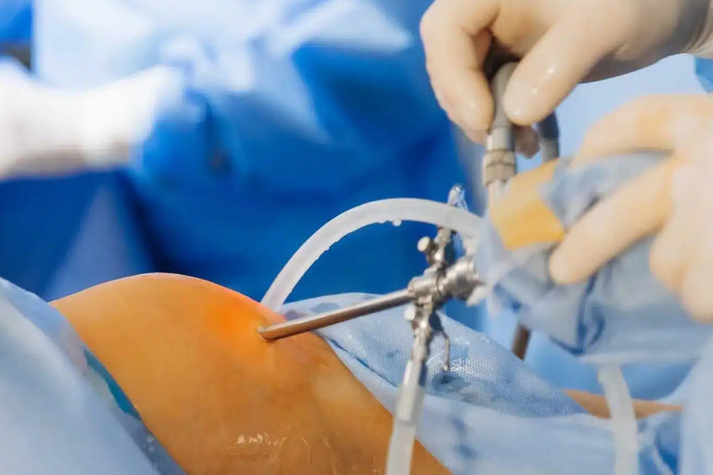 Advanced Fundoplication Surgery in Delhi