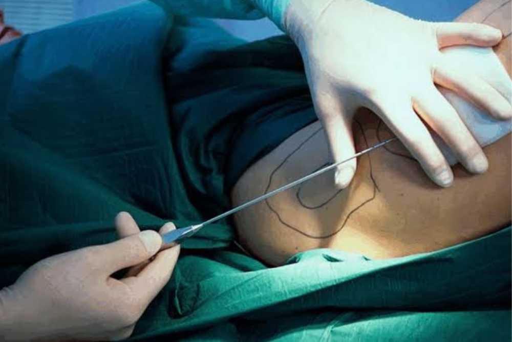 Advanced Hiatal Hernia Surgery in Delhi