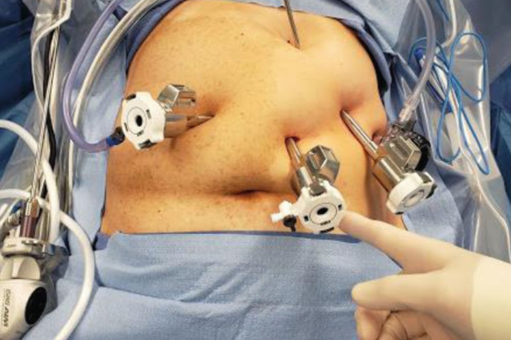 Advanced Paraesophageal Hernia Repair in Delhi
