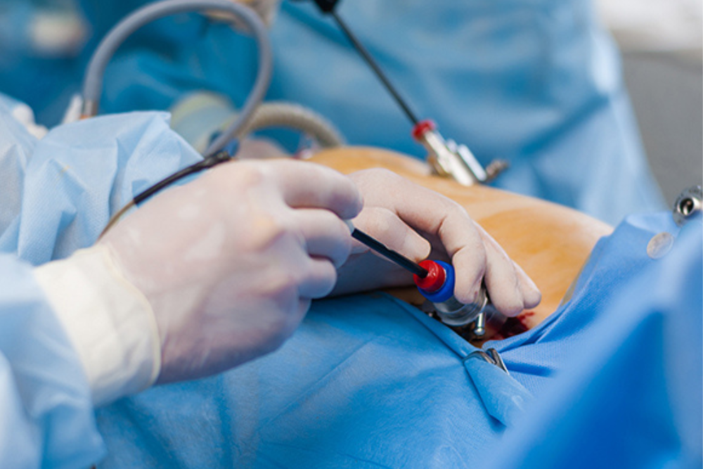 Advanced Gallbladder Polyp Surgery in Delhi