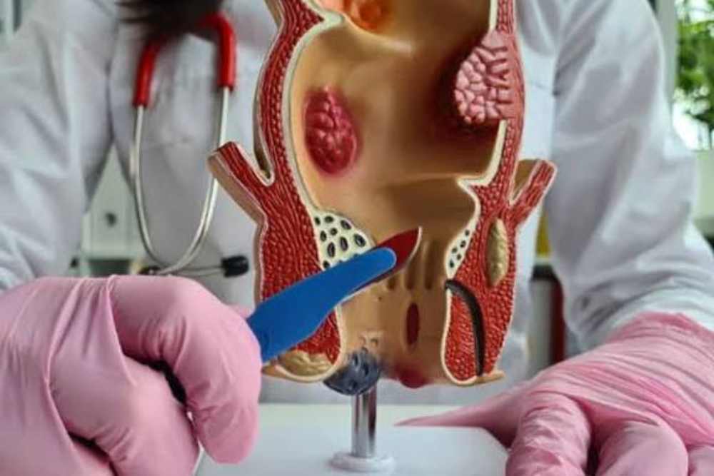 Advanced Piles Treatment in Delhi