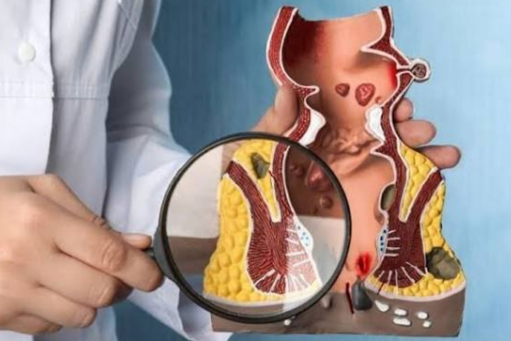 Advanced Anal Fissure Treatment in Delhi