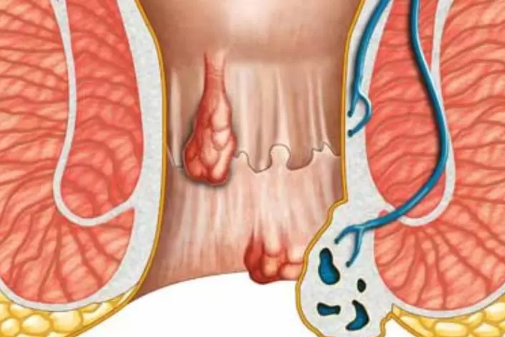 Advanced Anal Fistula Treatment in Delhi